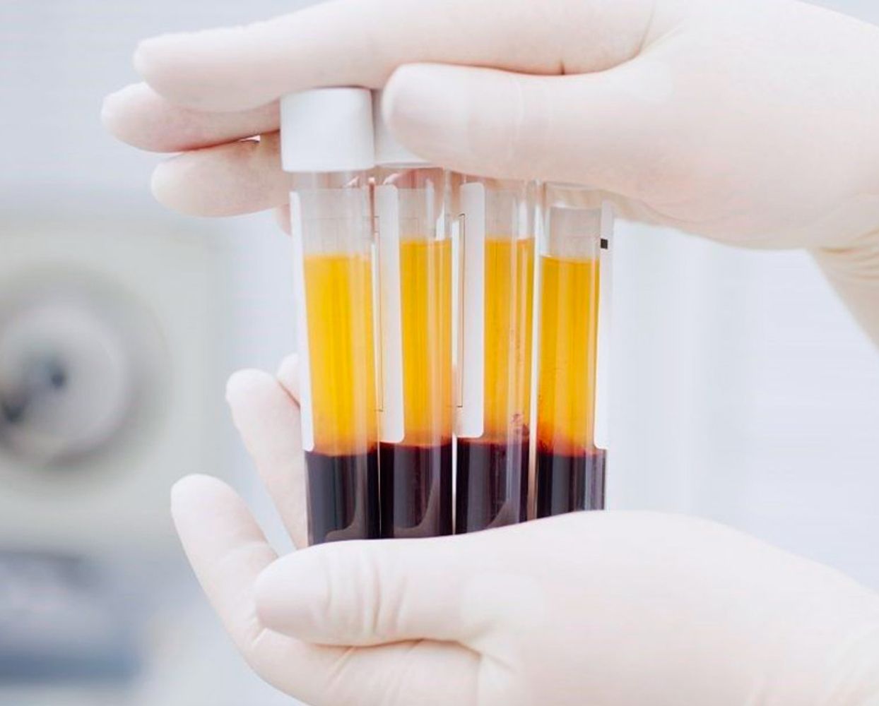 plasma rico en plaquetas (prp)